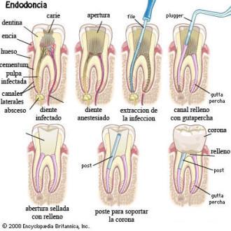 endodoncia - clínica dental barrero