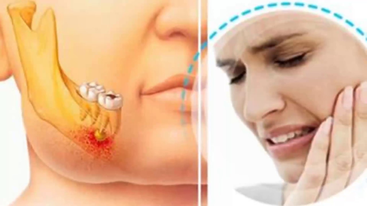 Síntomas de afectación al nervio dental